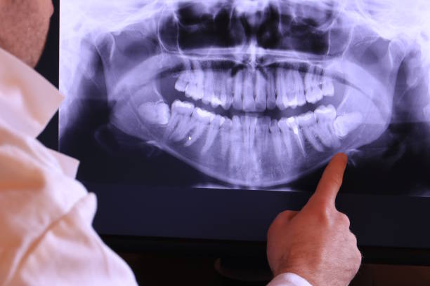 Best Knocked-Out Tooth (Avulsed Tooth) Treatment in Scarsdale, NY